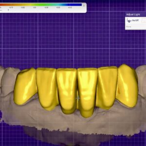 Temporary Crown & Bridge Design