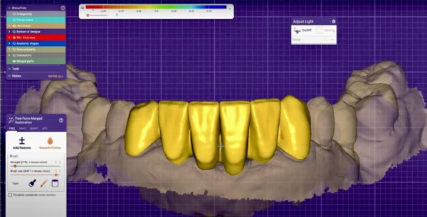 Temporary Crown & Bridge Design