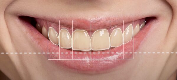Smile Design Plan - Image 2